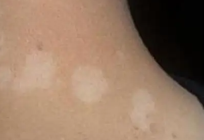 微量元素测定仪解读微量元素缺乏引起白斑的影响 微量元素测定仪解读微量元素缺乏引起白斑的影响